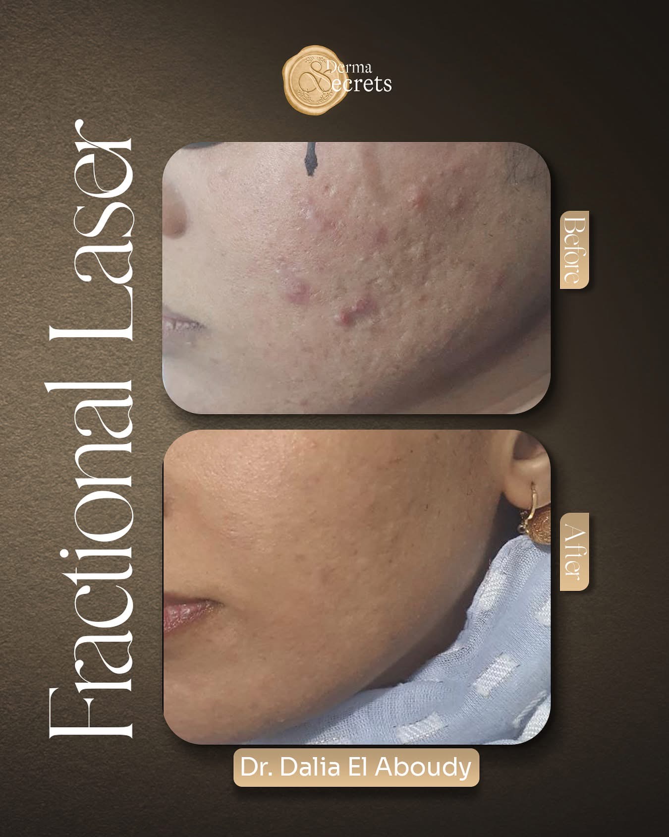 Acne & scars improvement